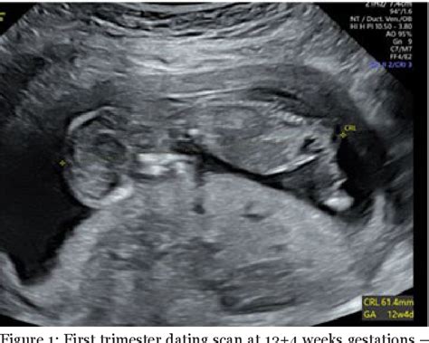 Figure 1 from A case of a massive placental lake in the second ...