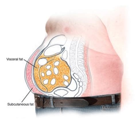 Stubborn Fat (Subcutaneous Fat) VS Visceral Fat - Elite Body Contouring