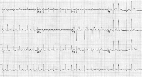 Atrial Fibrillation • LITFL • ECG Library Diagnosis