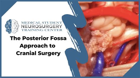 The Posterior Fossa Approach to Cranial Surgery - YouTube