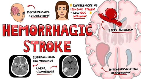 Intraparenchymal Hemorrhage Vs Subarachnoid Hemorrhage