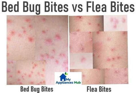 Bed Bug Bites vs Flea Bites: How to Tell the Difference and Get Relief ...