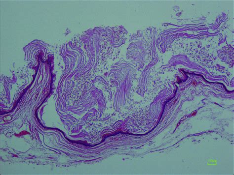 Histological slide of epidermoid cyst showing squamous epithelium ...