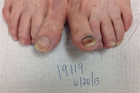 Toenail Fungus Before and After Photos - Advanced Podiatry of Manhasset ...