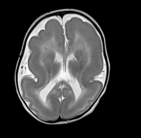 Lissencephaly Mri