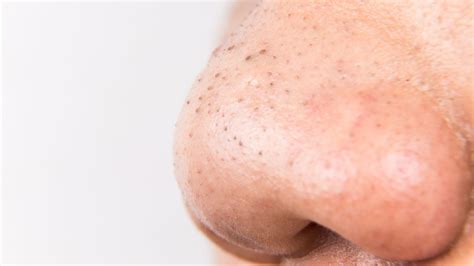 What Are Blackhead Pimples Actually Made of, and What's Inside? - Allure