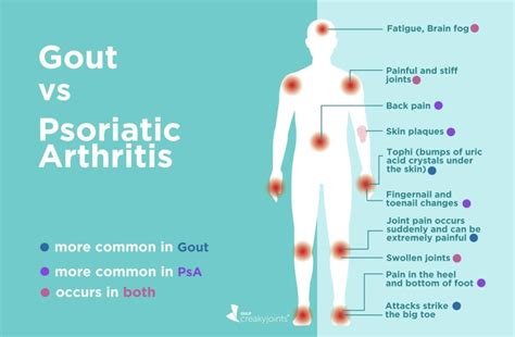 Gout vs. Psoriatic Arthritis: Differences in Symptoms and Treatments