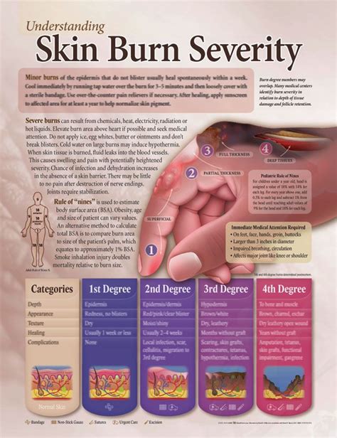 Understanding Skin Burn Severity anatomy poster for medical office and ...