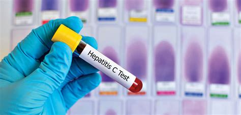 U.S. Looks to Implement One-Step Hepatitis C Diagnosis - Tu Salud