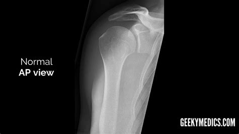 Shoulder X-ray Interpretation | Radiology | Geeky Medics