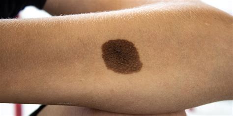 What Is Melanocytic Nevus And How To Treat It?