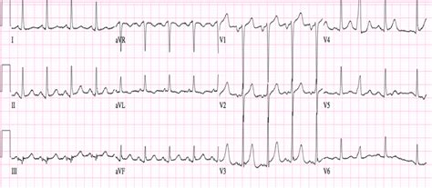 Atrial Enlargement On Ekg