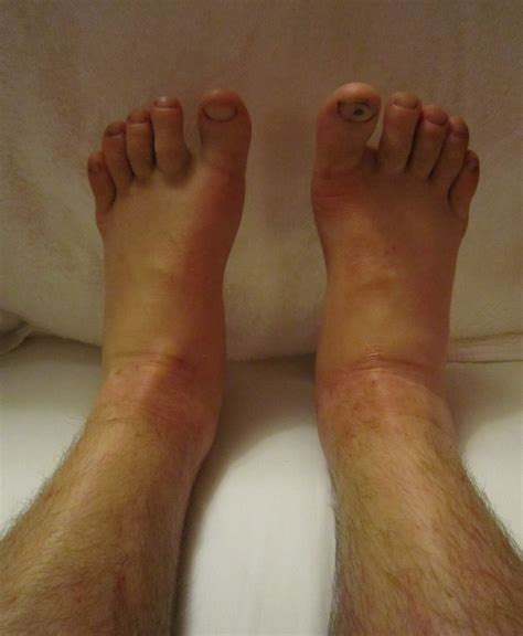 Bilateral Ankle Edema: Causes when Tests Are Normal » Scary Symptoms