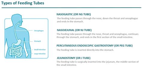 Types of Feeding Tube Info for HCPs | Nestlé Health Science