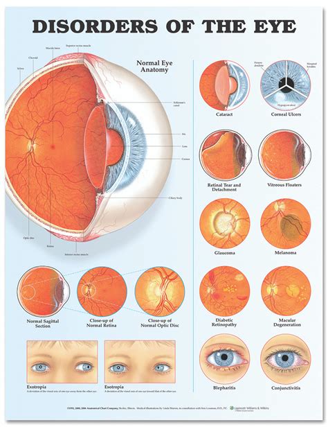 Reference Chart - Disorders of the Eye - Biologyproducts.com