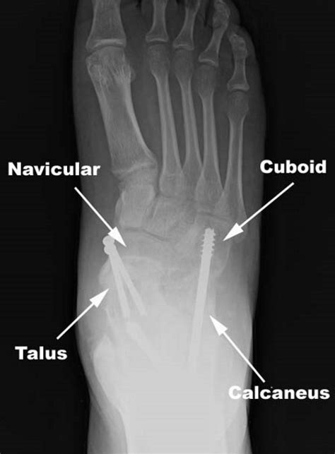 Triple Arthrodesis - Drwolgin