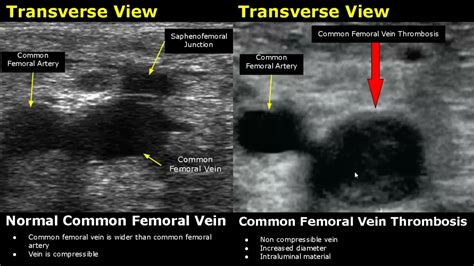 Femoral Artery Ultrasound