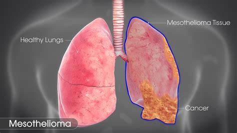 Mesothelioma: Symptoms, Causes, and Treatment - Scientific Animations