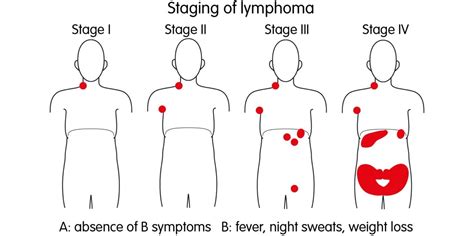 Hodgkin’s lymphoma Statistics, Symptoms & Treatment - Booboone.com