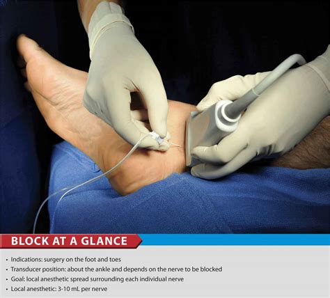 Ultrasound-Guided Ankle Block | Anesthesia Key