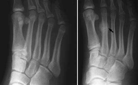 Metatarsal Stress Fracture – Podiatry Network