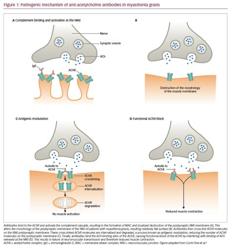 Myasthenia Gravis / Myasthenia Gravis Autoantibody Characteristics And ...