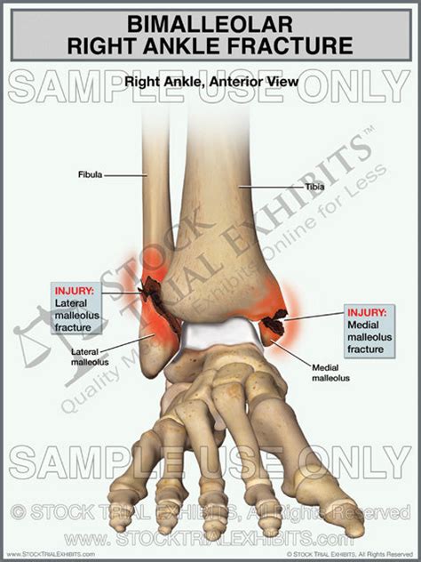 Bimalleolar Right Ankle Fracture – Stock Trial Exhibits