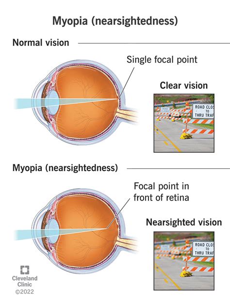 Myopia (Nearsightedness): Causes, Symptoms &Treatment