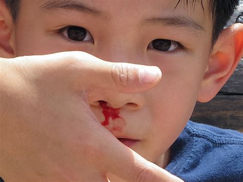 Nosebleeds In Kids: A Guide To Treatment And Prevention