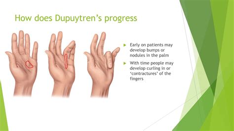 Dupuytren's Contracture Treatment - Everything You Need to Know - YouTube