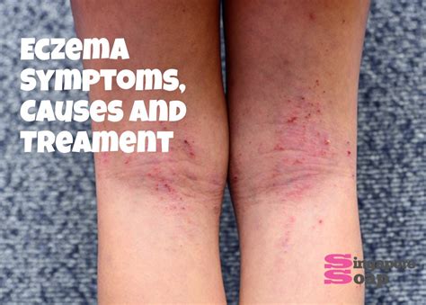 [10000印刷√] eczema causes 129239-Eczema causes and treatment