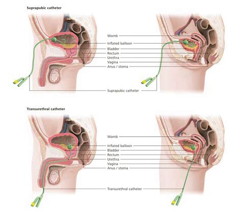 Indwelling catheter