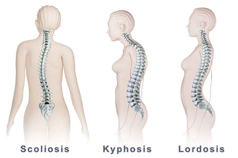 Degenerative Scoliosis | Cervical, Thoracic & Lumbar Spine Surgery ...