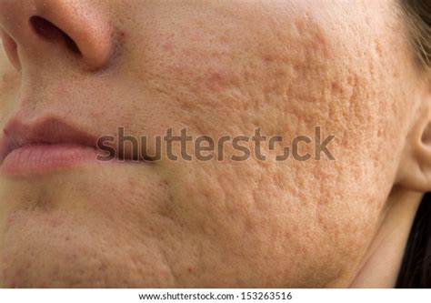 Girl Problematic Skin Acne Scars Stock Photo 153263516 | Shutterstock