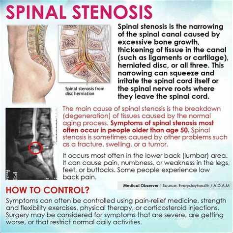 13 best images about spinal stenosis on Pinterest | Names, She does and ...