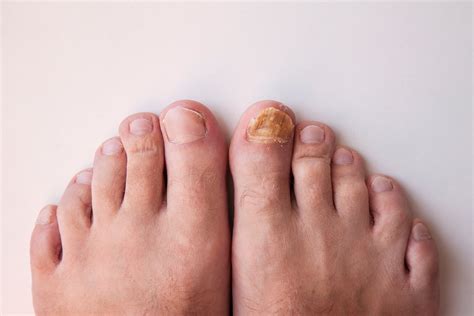 What Causes Toenail Fungus & How Can It Be Treated? | Arizona Foot Doctors