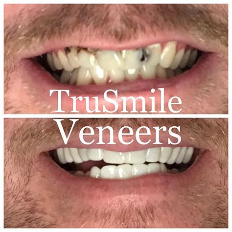 Best Snap On Veneers 2024 - Cammy Caressa