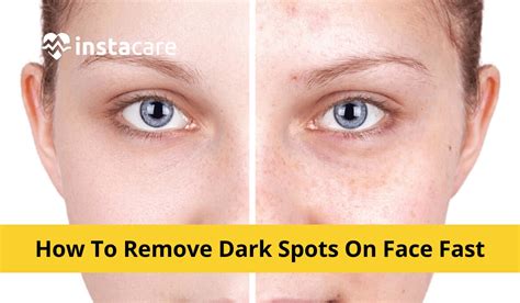 How to Remove Dark Spots on Face Fast? 7 Natural Remedies