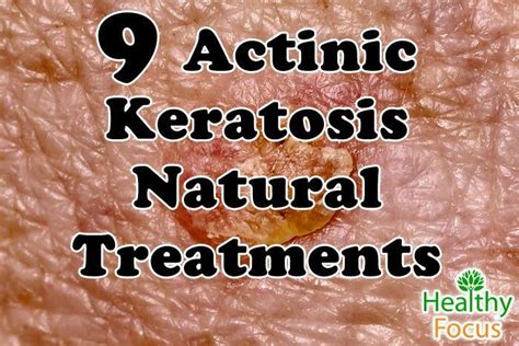 9 Tested Actinic Keratosis Natural Treatments | Essential oil ...