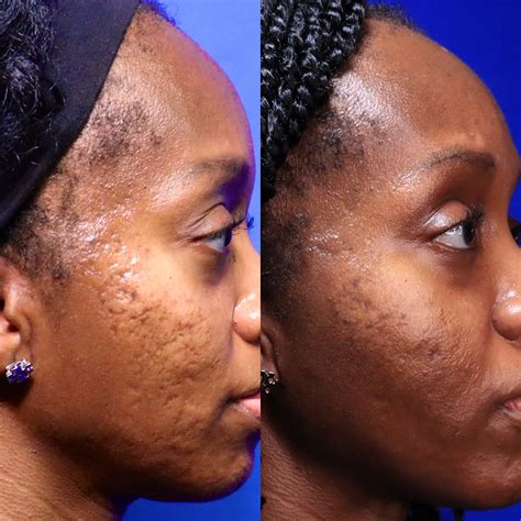 Acne Scar Treatment for Patients of African Descent