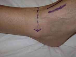 Ankle Block - Pain Management - Pharmacological Sciences