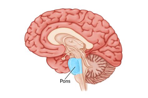 Lateral Pontine Syndrome Mri