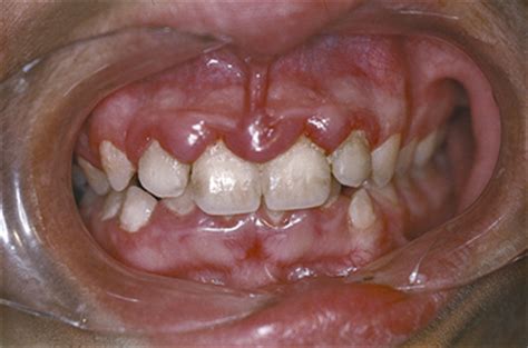 Linear Gingival Erythema