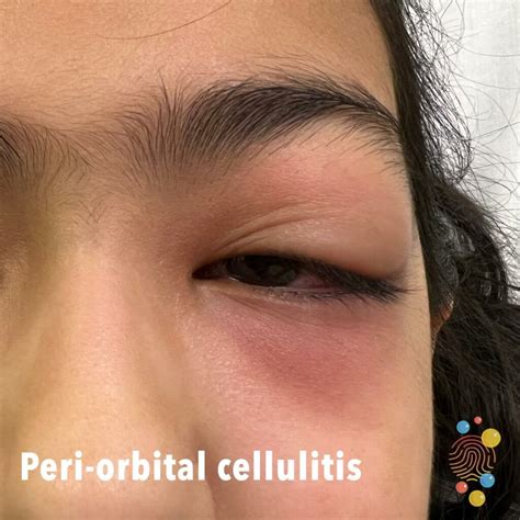 Periorbital Cellulitis Vs Orbital Cellulitis