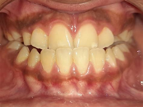 Understanding Crossbite: Causes, Symptoms, & Treatments