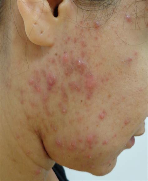 ACD A-Z of Skin - Acne Vulgaris