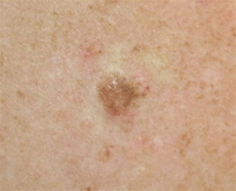 Seborrhoeic keratosis, papilloma | London Mole Removal