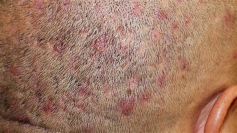 Folliculitis Scalp