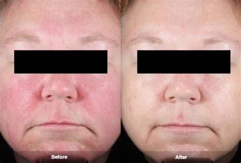 Rosacea Treatment Photos | Rosacea.org