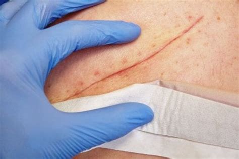 Basic Wound Closure Techniques - Step To Health